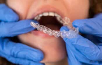 Orthodontic Emergencies: What to Do When Braces or Aligners Cause Discomfort